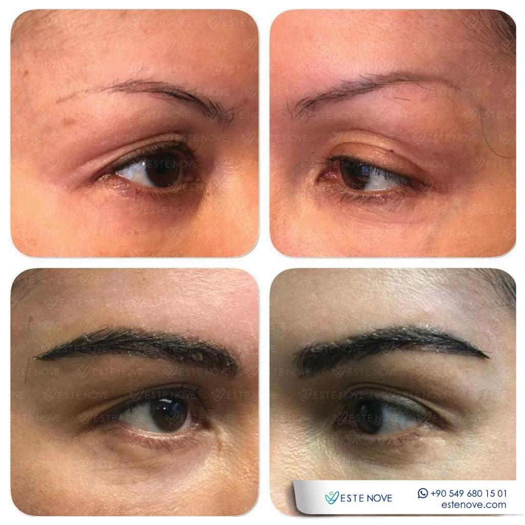 Eyebrow Transplant Before After