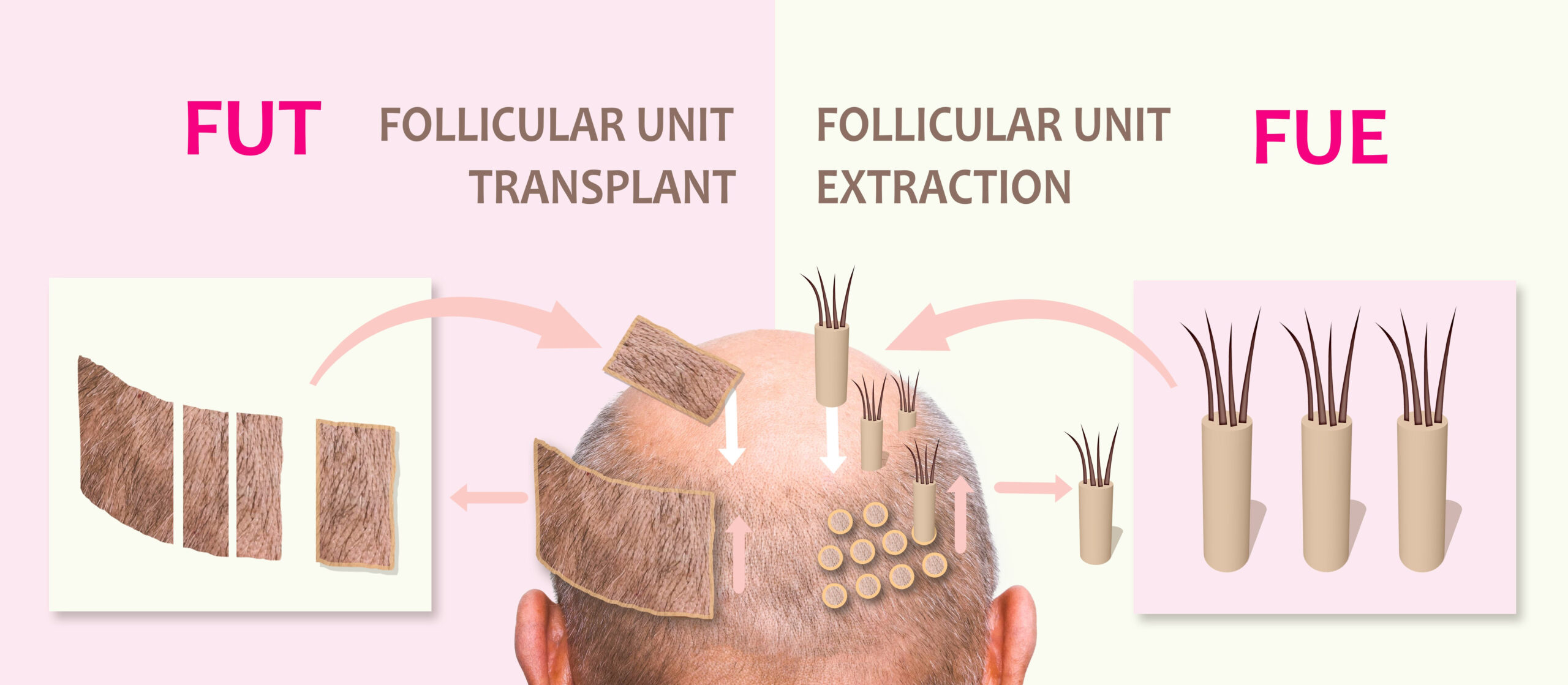 Greffe de Cheveux FUT vs FUE