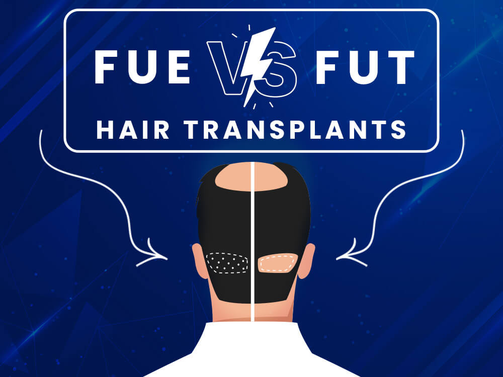 Diagram comparing the extraction methods of FUE and FUT hair transplant techniques.