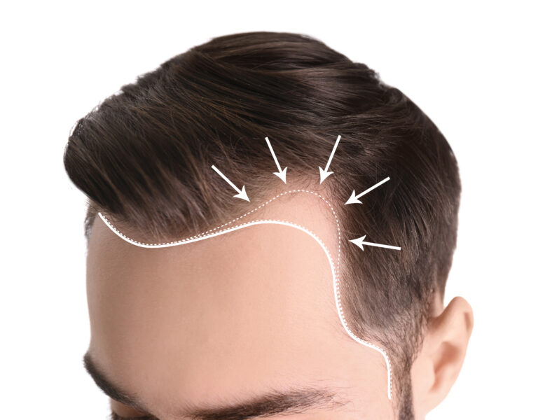 Demonstration of receding hairline from temples