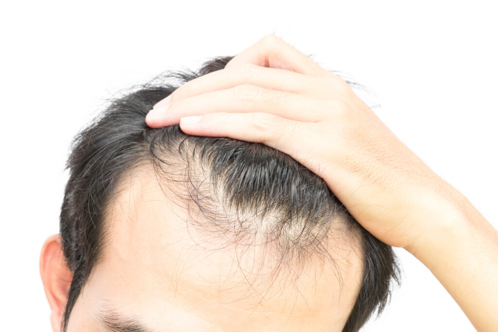 Close-up of a person pulling back hair to show early-stage receding hairline at the temples.