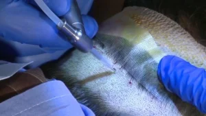 Neograft Application in Hair Transplant -2