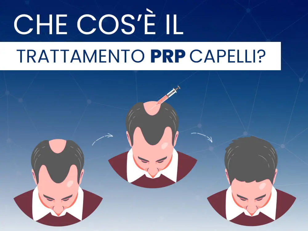 Che cos’è il trattamento PRP capelli