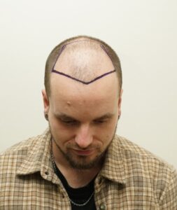 Front view of a patient with low hair density and marked donor/recipient areas for hair transplant planning.