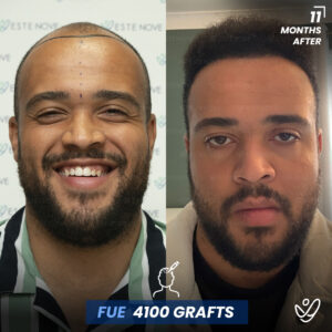 before and 11 months after photos of a man with hair transplant, 4100 grafts and FUE method used
