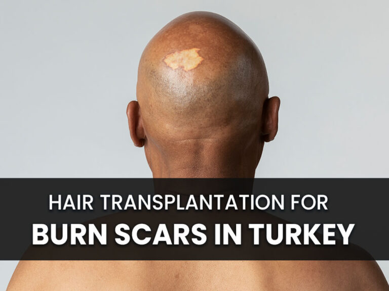 Bald man with burn scar in his head and text saying Hair Transplantation for Burn Scars in Turkey