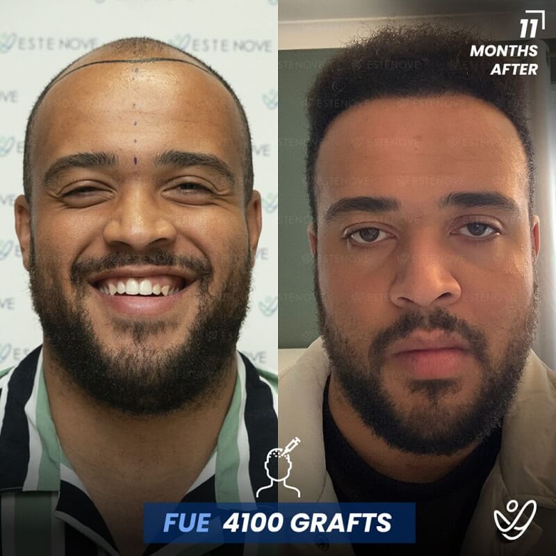 Male FUE 4100 grafts 11 Months Before&After