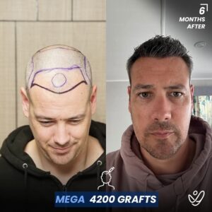 Male Mega 4200 grafts 6 Months Before&After