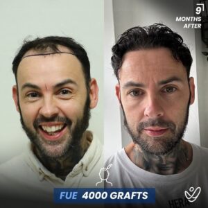 Male FUE 4000 grafts 9 Months Before&After