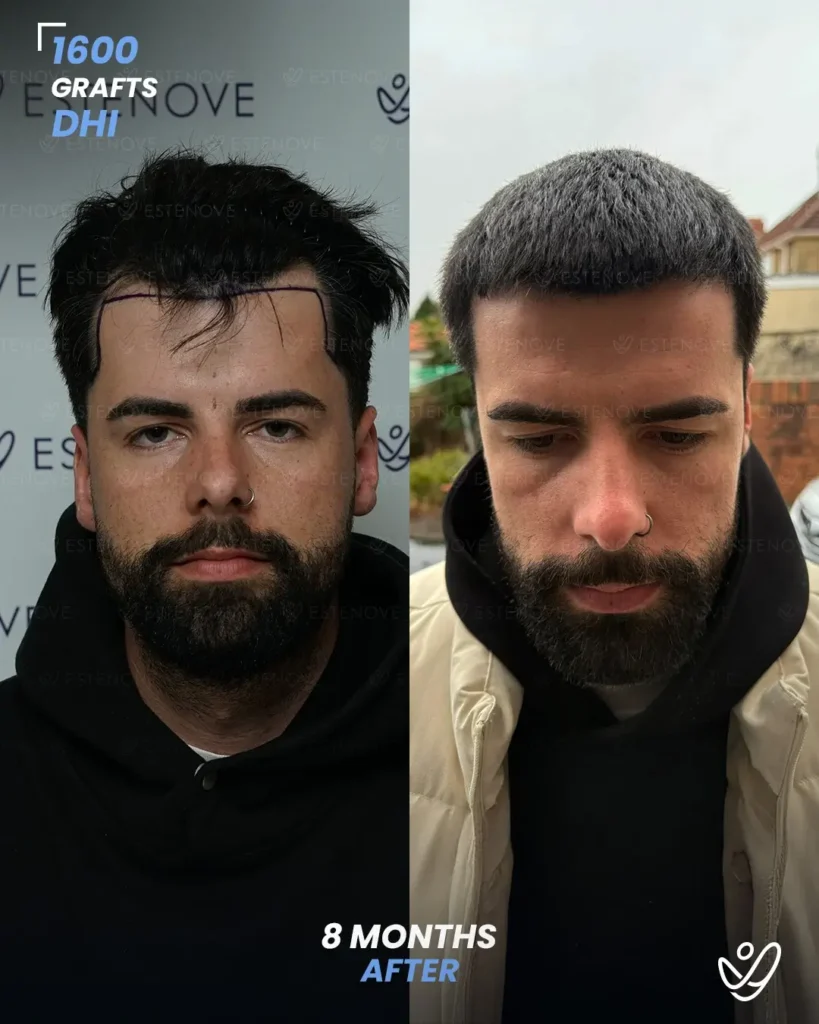 1600 graft DHI 8 months before & after hair transplant