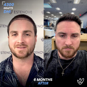 Male DHI 4300 Grafts 6 Months Before&After