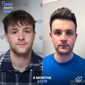 Male DHI 2100 Grafts 6 Months Before&After