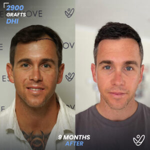Male DHI 2900 Grafts 9 Months Before&After