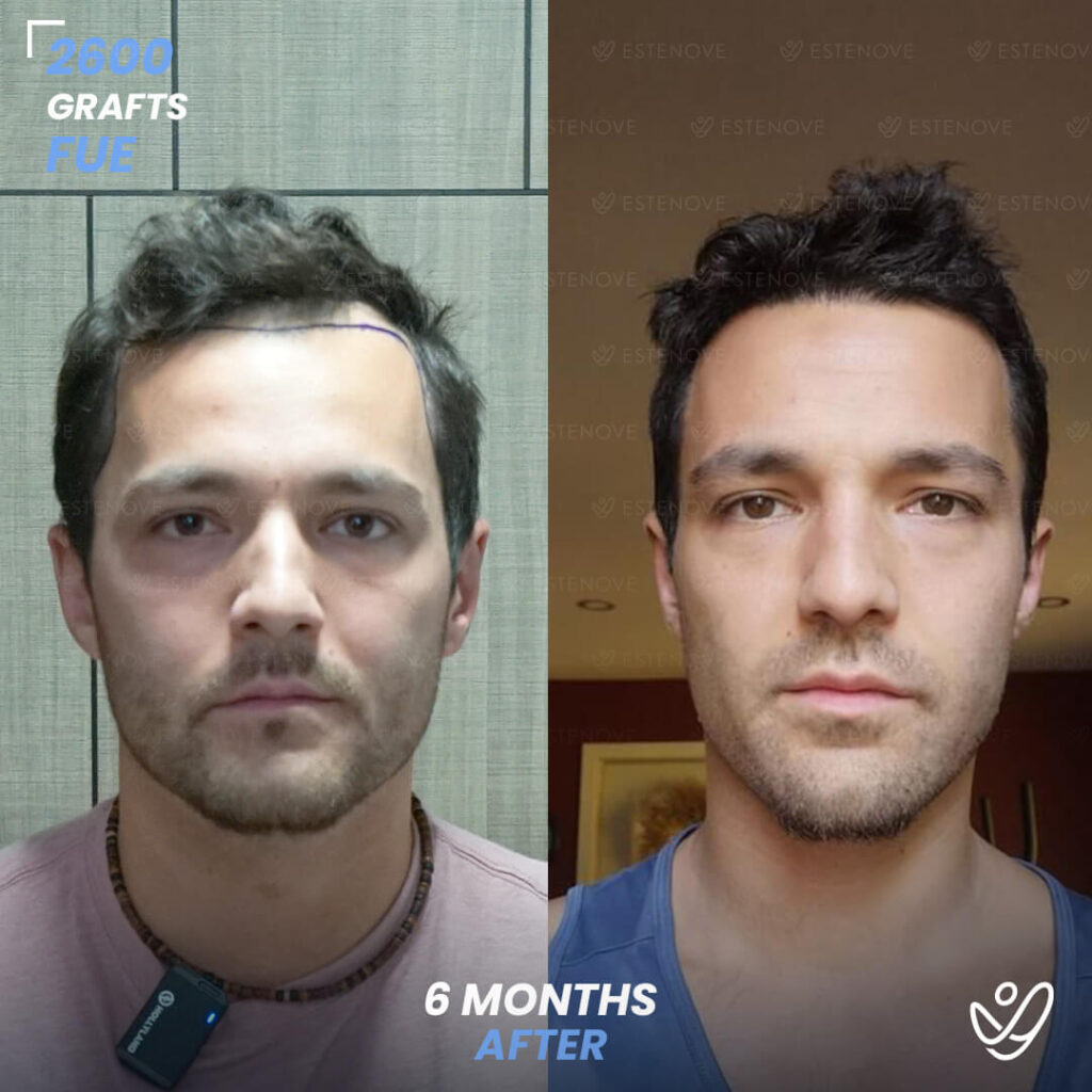 Male DHI 2600 Grafts 6 Months Before&After