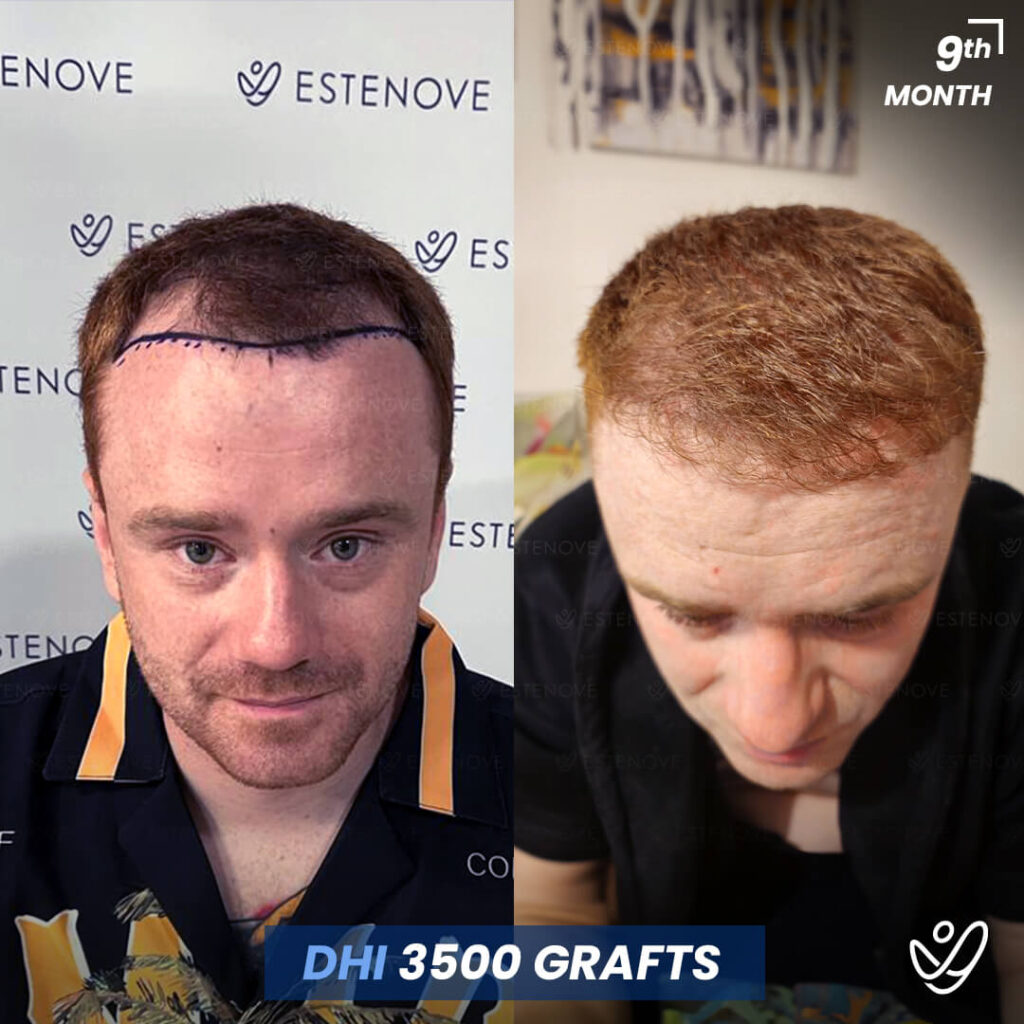 Male DHI 3500 Grafts 9 Months Before&After Male DHI 3500 Grafts 9 Months Before&After