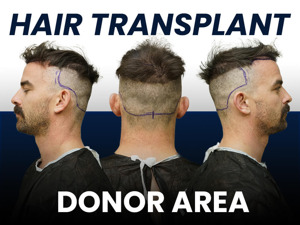 text saying hair transplant donor area, photo of a man with marked donor are on the back of his head