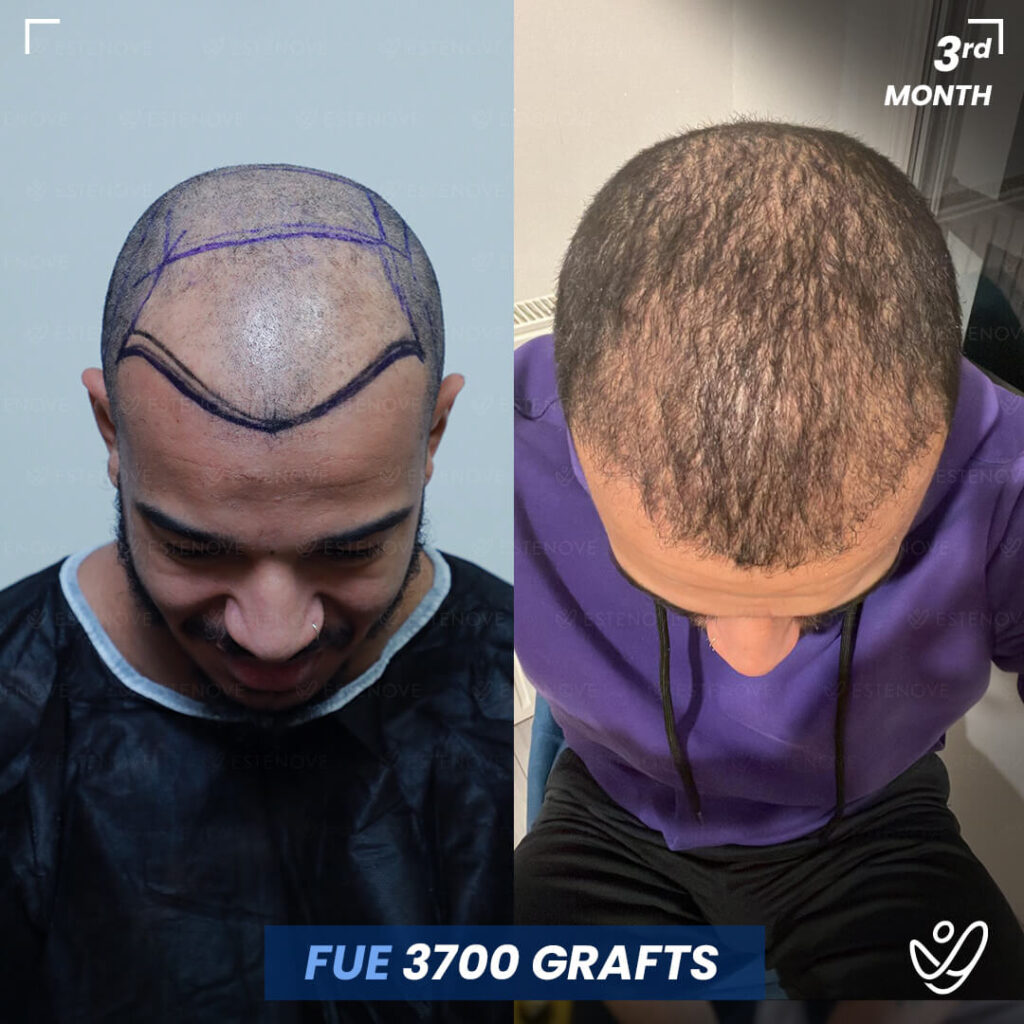 Male, DHI, 3 Months After Hair Transplant, 3700 Grafts