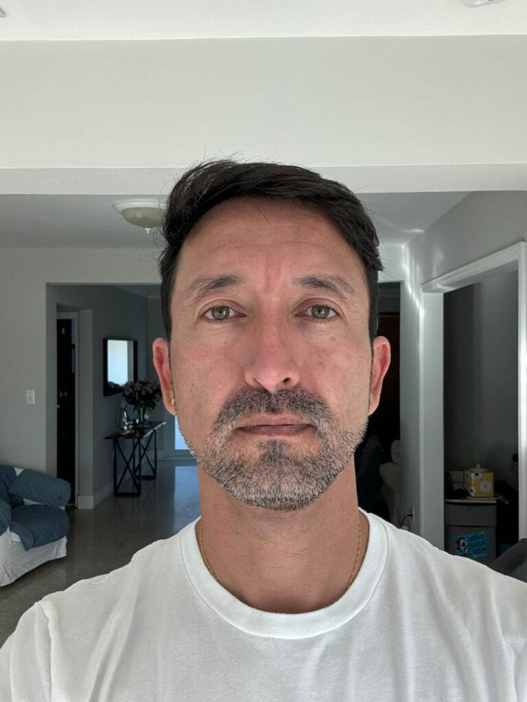 Man after Second Hair Transplant Photo (2950 Grafts)
