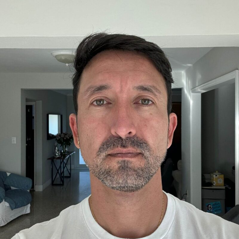 WhatsApp Image 2023-10-31 at 16.32.21 (1) Man after Second Hair Transplant Photo (2950 Grafts)