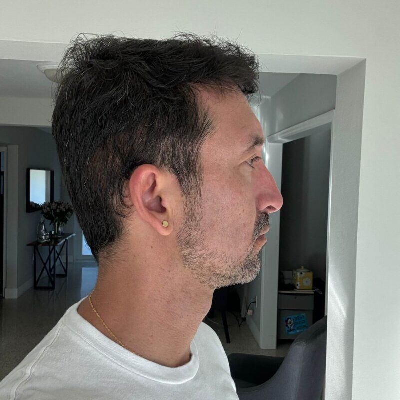 WhatsApp Image 2023-10-31 at 16.32.22 (1) After Second Hair Transplant Photo (2950 Grafts)