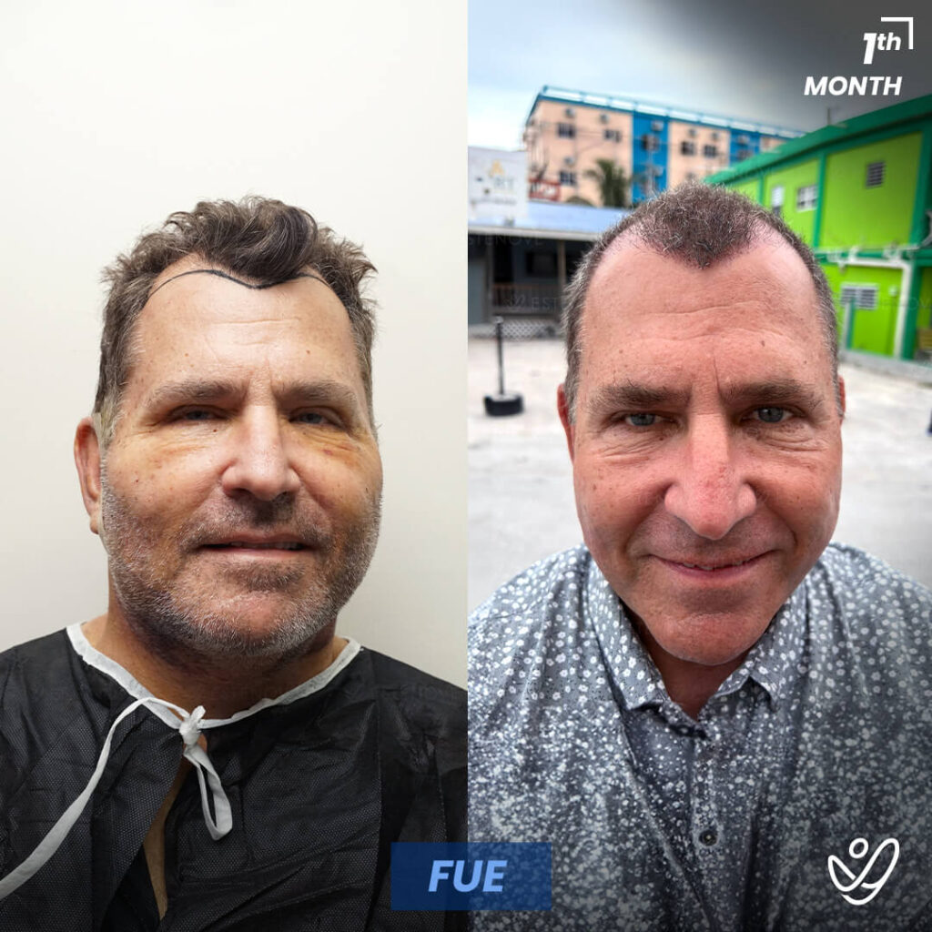 Male FUE Hair Transplant, 1 Month After Male FUE Hair Transplant, 1 Month After