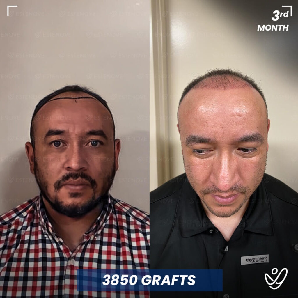 Male, DHI, 3 Months After Hair Transplant, 3850 Grafts