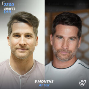 DHI 2300 Hair Grafts, 9 Months Before After