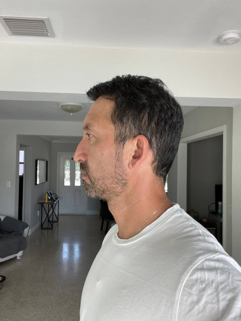 man After First Hair Transplant (5200 Grafts)