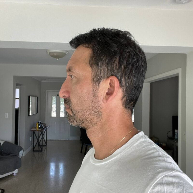 Copy of WhatsApp Image 2023-01-10 at 23.08.57 (1) man After First Hair Transplant (5200 Grafts)