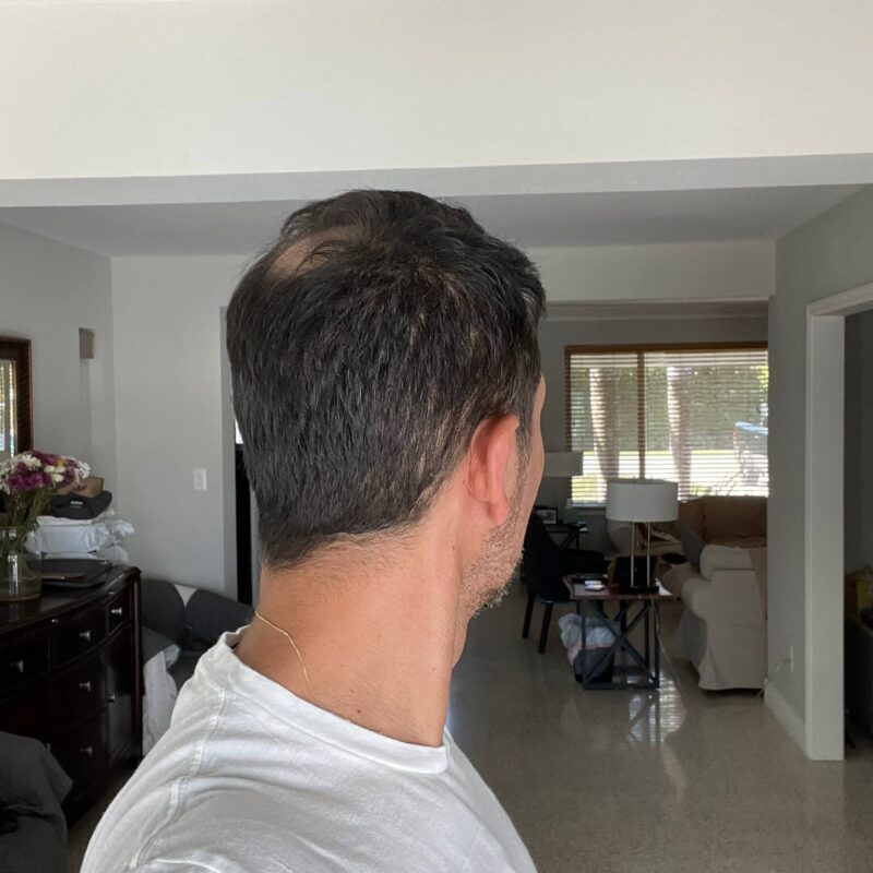 Copy of WhatsApp Image 2023-01-10 at 23.08.57 After First Hair Transplant Photos (5200 Grafts)