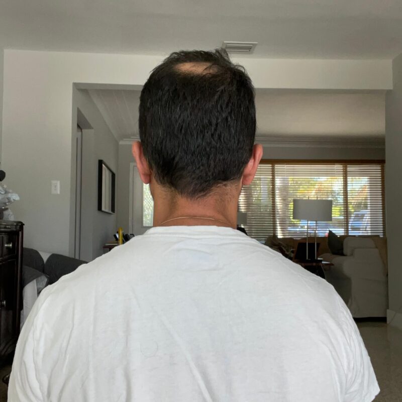 Copy of WhatsApp Image 2023-01-10 at 23.08.58 After First Hair Transplant Photo (5200 Grafts)