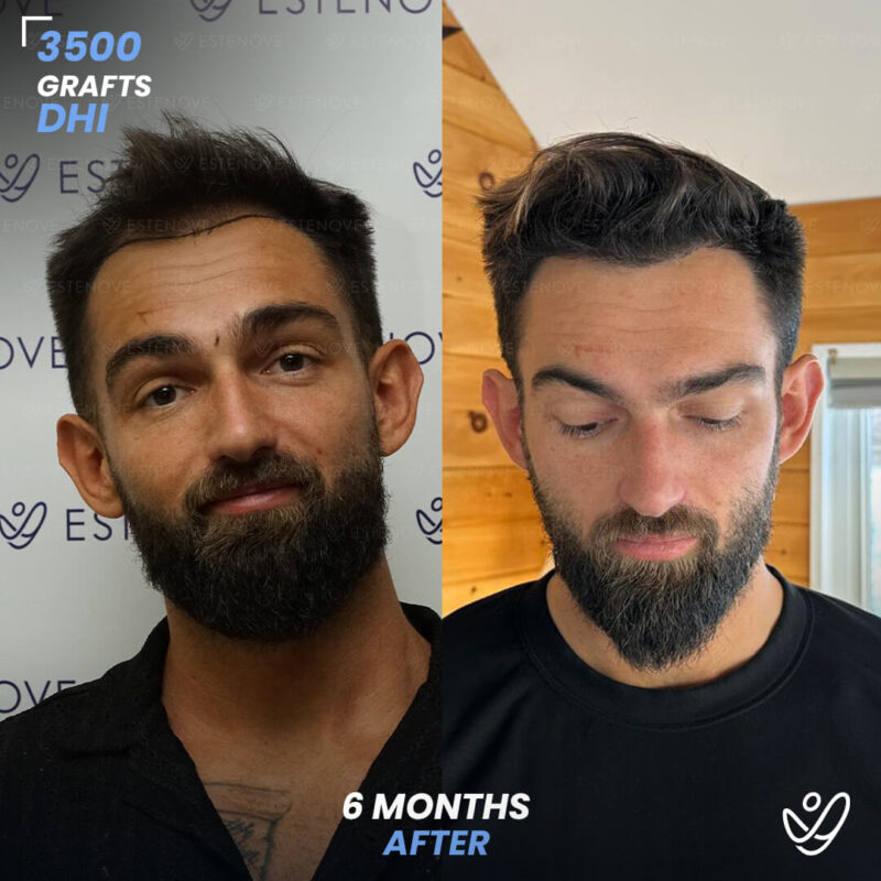 DHI 3500 Hair Grafts, 6 Months Before After - Randy Lehoe DHI 3500 Hair Grafts, 6 Months Before After - Randy Lehoe