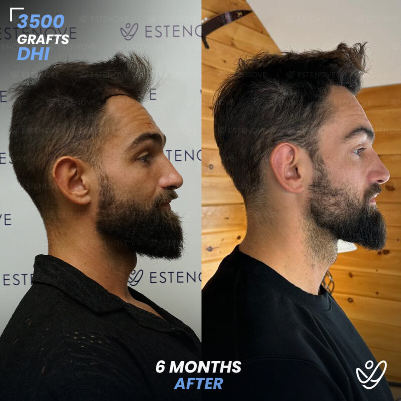 DHI 3500 Hair Grafts, 6 Months Before After - Randy Lehoe DHI 3500 Hair Grafts, 6 Months Before After - Randy Lehoe