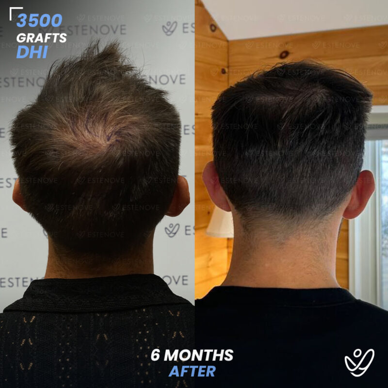DHI 3500 Hair Grafts, 6 Months Before After - Randy Lehoe DHI 3500 Hair Grafts, 6 Months Before After - Randy Lehoe