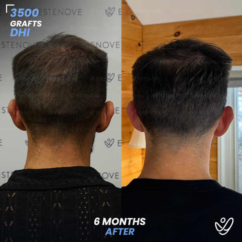 DHI 3500 Hair Grafts, 6 Months Before After - Randy Lehoe DHI 3500 Hair Grafts, 6 Months Before After - Randy Lehoe