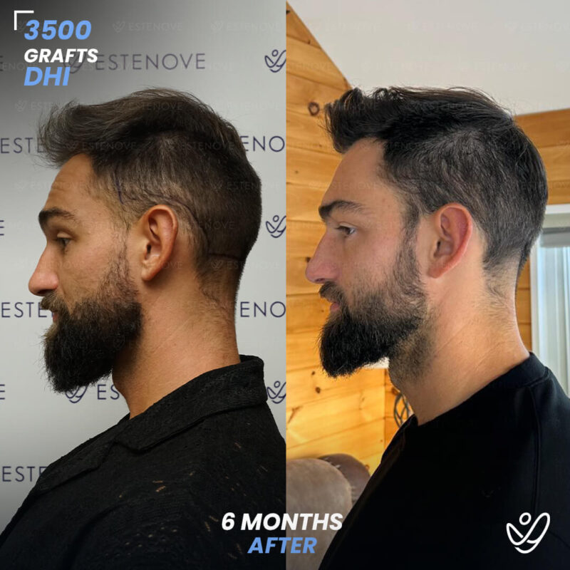 DHI 3500 Hair Grafts, 6 Months Before After - Randy Lehoe DHI 3500 Hair Grafts, 6 Months Before After - Randy Lehoe