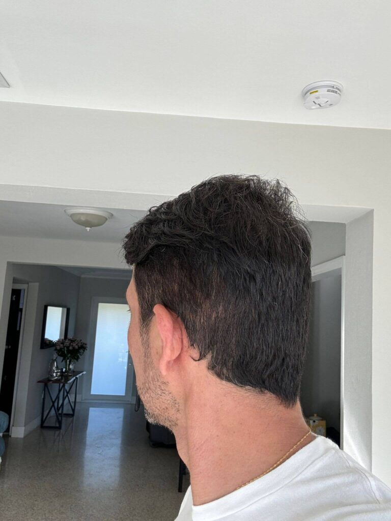 After Second Hair Transplant Photo (2950 Grafts)