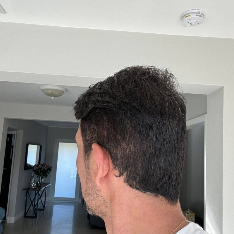 WhatsApp Image 2023-10-31 at 16.32.23 (1) (1) After Second Hair Transplant Photo (2950 Grafts)