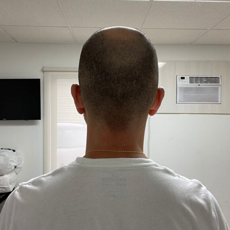 Before Hair Transplant Photo Before Hair Transplant Photo