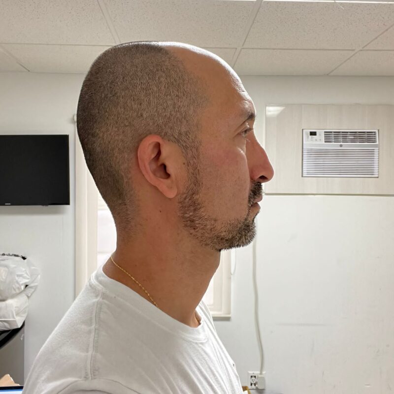 Before Hair Transplant Photo Before Hair Transplant Photo
