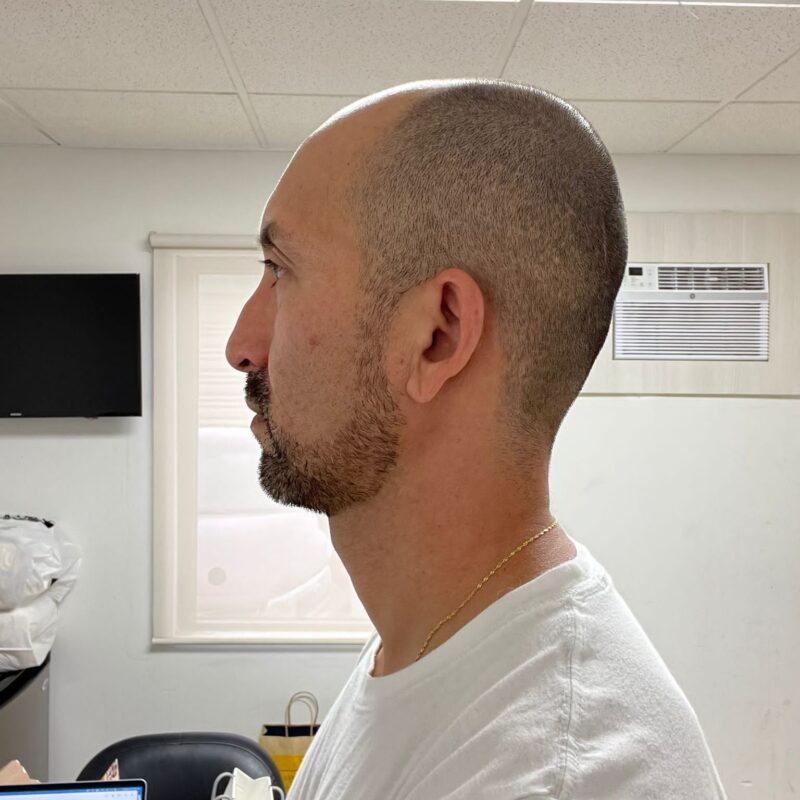 Before Hair Transplant Photo Before Hair Transplant Photo