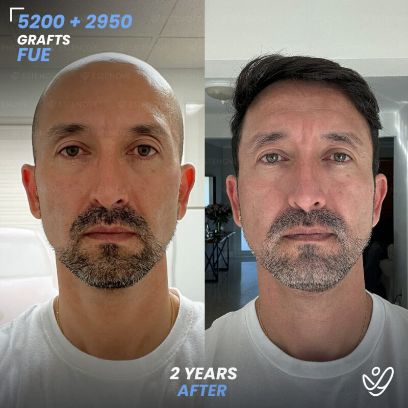 Wilmer_Sanchez_1 Second Hair Transplant Before After - FUE 5200 + 2950 Grafts - Wilmer Sanchez