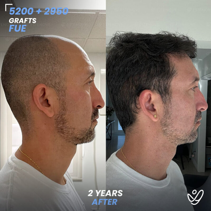 Wilmer_Sanchez_2 Second Hair Transplant Before After - FUE 5200 + 2950 Grafts - Wilmer Sanchez