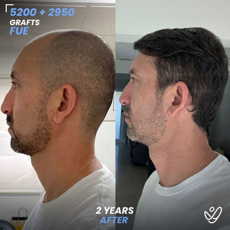Wilmer_Sanchez_3 Second Hair Transplant Before After - FUE 5200 + 2950 Grafts - Wilmer Sanchez