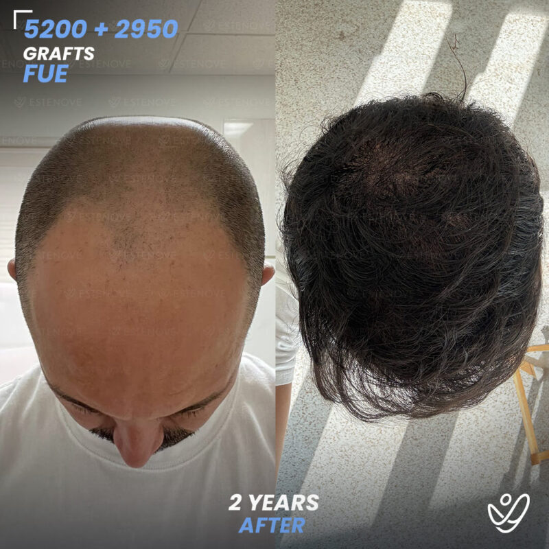 Wilmer_Sanchez_4 Second Hair Transplant Before After - FUE 5200 + 2950 Grafts - Wilmer Sanchez