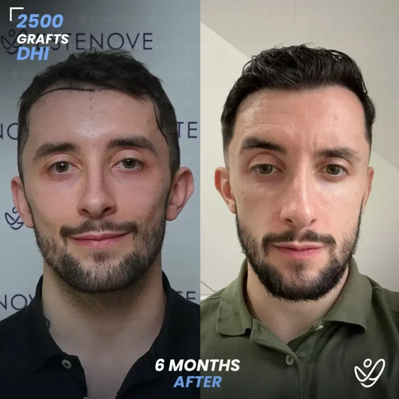 DHI 2500 grafts hair transplant 6 months after DHI 2500 grafts hair transplant 6 months after