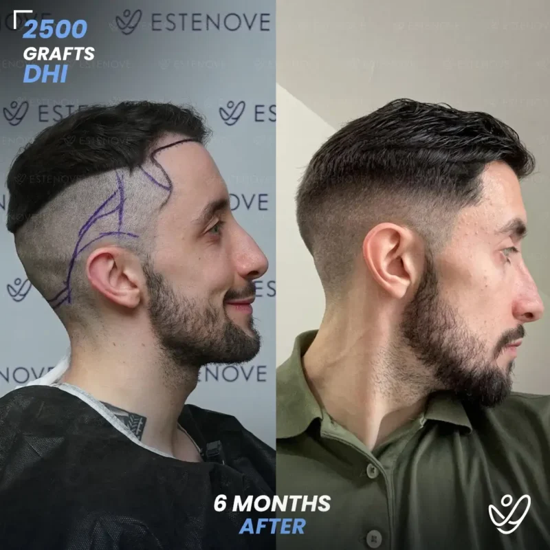 DHI 2500 grafts hair transplant 6 months after DHI 2500 grafts hair transplant 6 months after