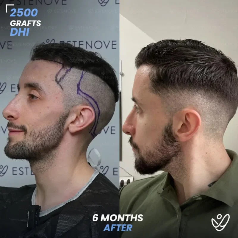 DHI 2500 grafts hair transplant 6 months after DHI 2500 grafts hair transplant 6 months after