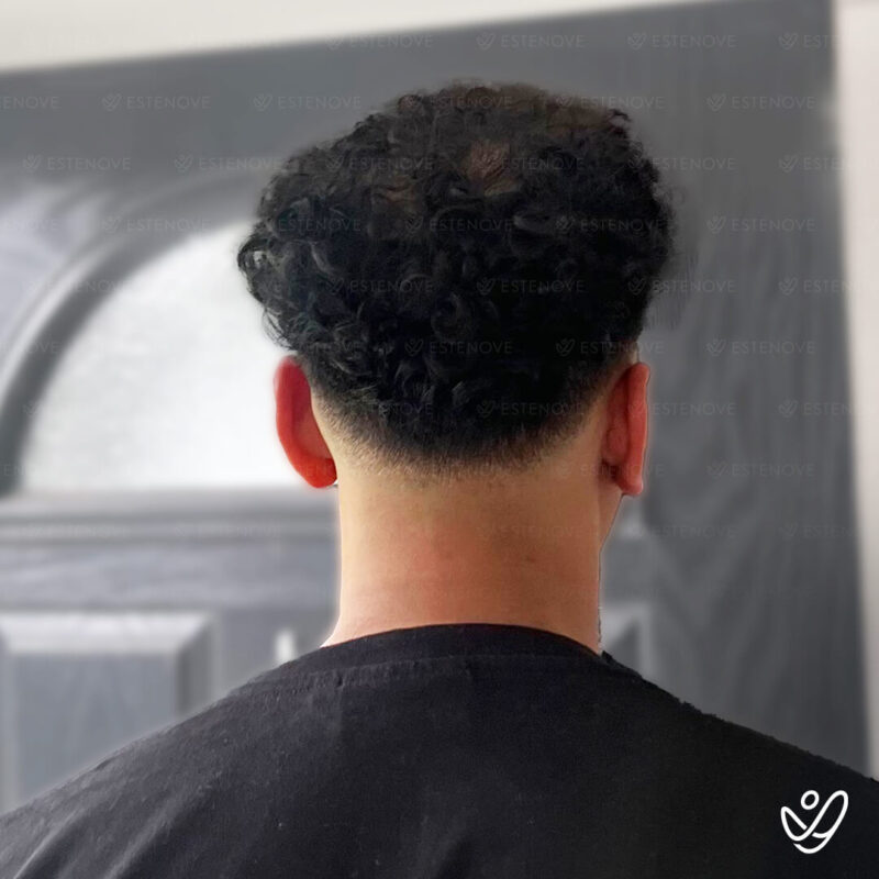 3200 Grafts Hair Transplant After Photo - Behind 3200 Grafts Hair Transplant After Photo - Crown