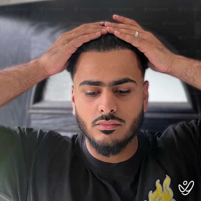3200 Grafts Hair Transplant After Photo - Hairline 3200 Grafts Hair Transplant After Photo - Hairline